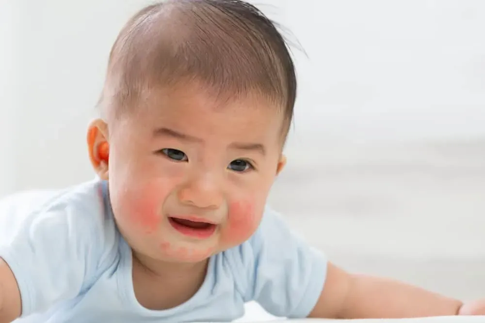 ff6810f0-iritasi-kulit-bayi.webp